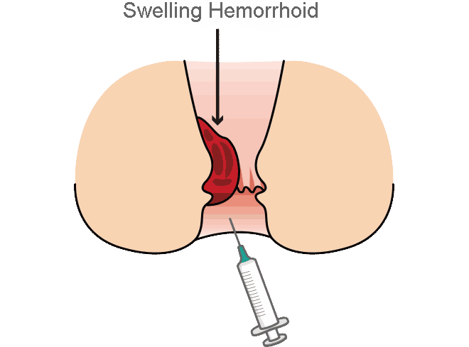 Hemorrhoid