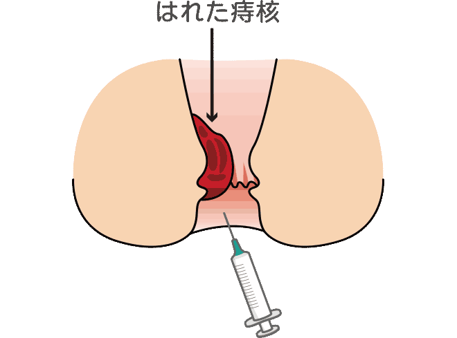 内痔核